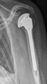 Proximaler Oberarmbruch10